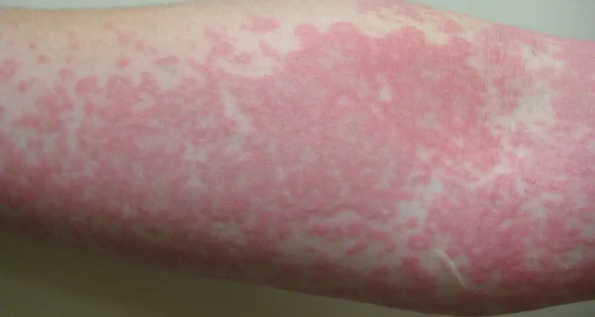 Brazo con extensas ronchas rojas en la piel, indicando una posible reacción alérgica o irritación cutánea.