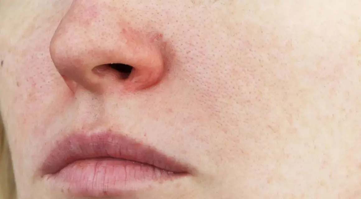 Rote Gesichtshaut Ursachen: Verborgene Gründe und wirksame Lösungen