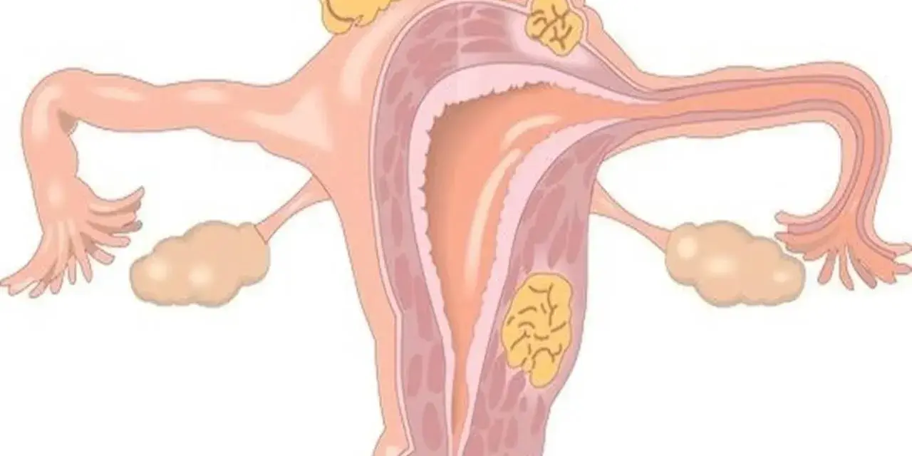 Anatomical illustration of a uterus with fibroids. Warto wiedzieć, ile cm ma macica, by monitorować jej stan.