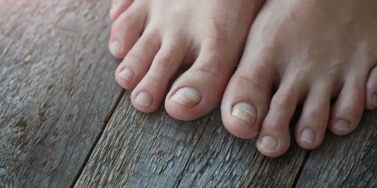 Dedos de los pies con uñas afectadas por tipos hongos en los pies, mostrando decoloración y engrosamiento.