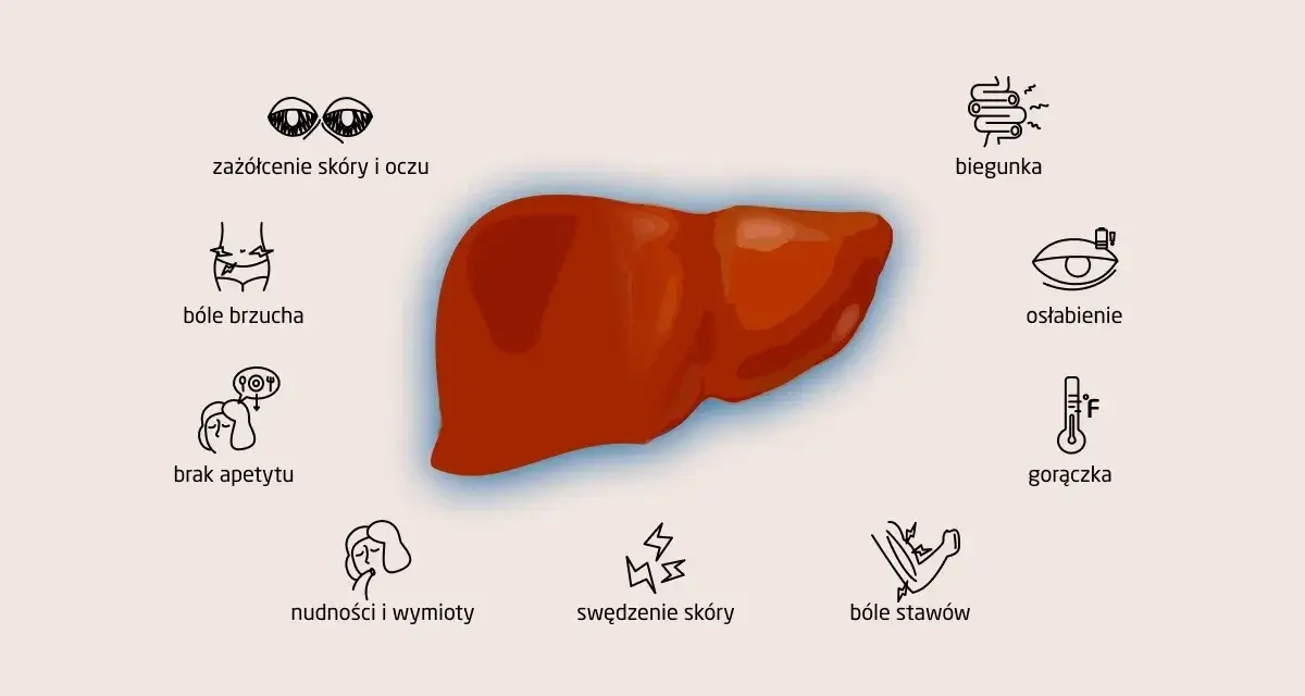 Objawy zapalenia wątroby typu A: zażółcenie skóry, bóle brzucha, brak apetytu, nudności, biegunka, osłabienie, gorączka, bóle stawów, swędzenie skóry.