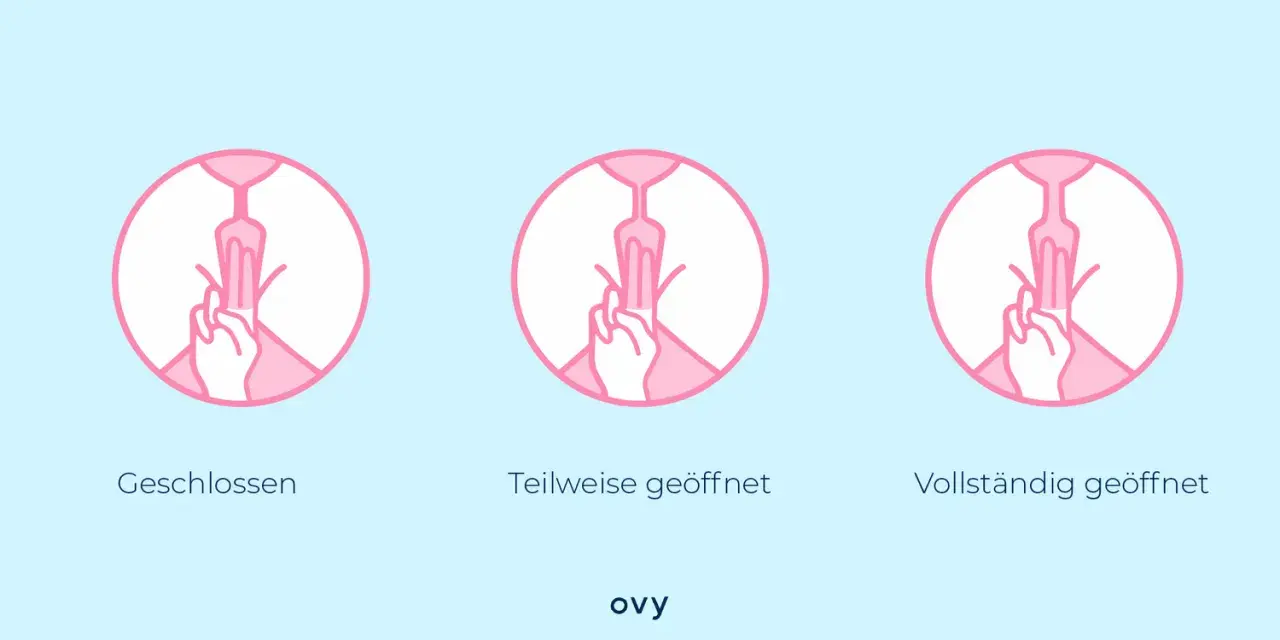 Darstellung des Muttermunds: geschlossen, teilweise geöffnet, vollständig geöffnet. Dies kann sich vor der Periode ändern.