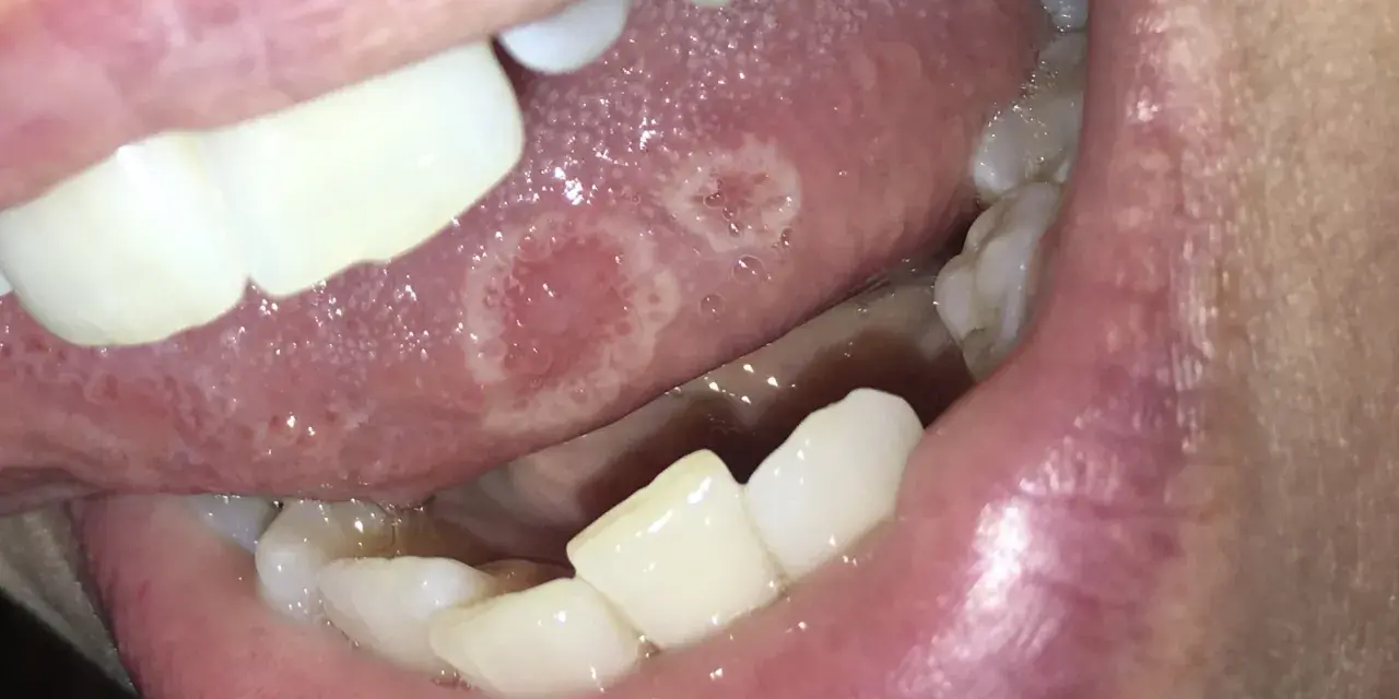 Lingua con afte dolorose. Le lesioni biancastre e rosse sono visibili sulla superficie della lingua, circondate da un alone infiammato.