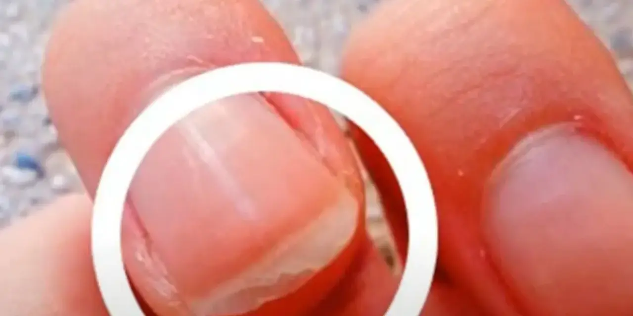 Gros plan sur un ongle qui se dédouble, montrant les couches séparées. Comprendre pourquoi les ongles se dédoublent peut aider à prévenir ce problème.