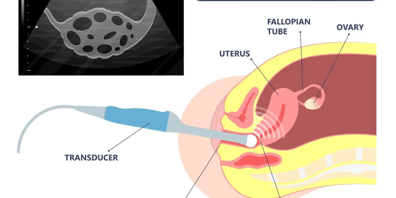 Transvaginaler Ultraschall zur Diagnose von Endometriose. Ein Ultraschallkopf wird in die Vagina eingeführt, um Gebärmutter, Eierstöcke und Eileiter abzubilden.