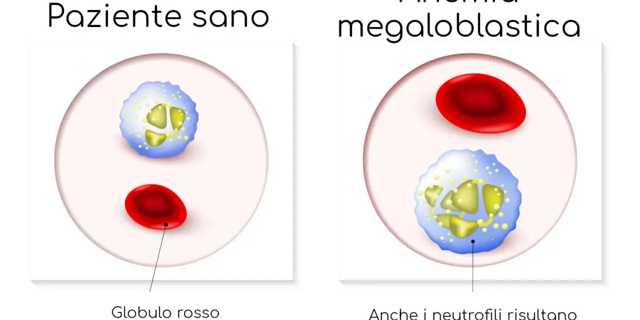 Confronto tra globuli rossi e neutrofili di un paziente sano e uno con anemia megaloblastica, dove i neutrofili appaiono alterati.