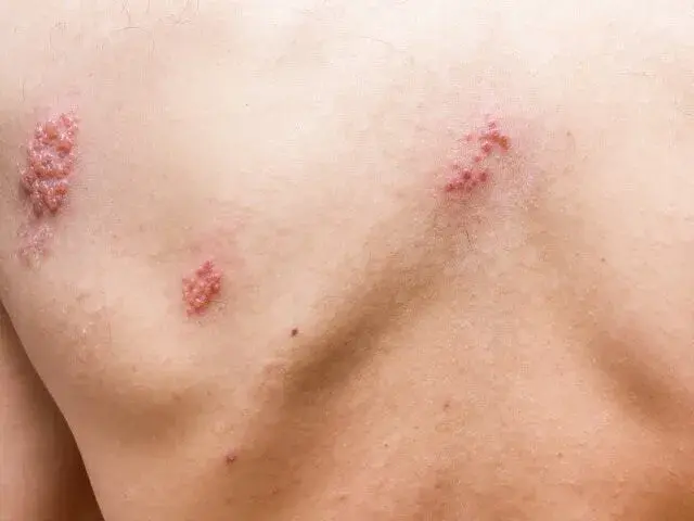 Jakie leki przeciwbólowe na półpasiec pomogą złagodzić ból?