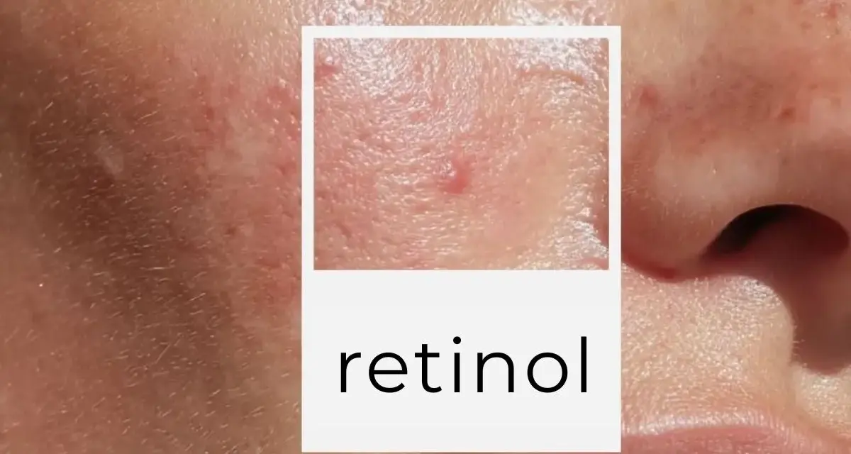 Skóra po dermapenie, widoczne drobne blizny i zaczerwienienia. W ramce napis "retinol", sugerujący pielęgnację.