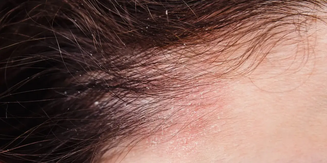 Nahaufnahme der Kopfhaut mit roten, schuppigen Stellen und feinen Haaren. Dies deutet auf Schuppenflechte am Kopfhautrand hin, die auch Haarausfall verursachen kann.