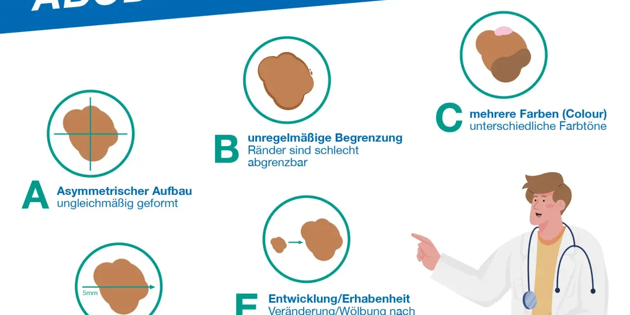 ABCDE-Regel: Asymmetrie, Begrenzung, Color, Durchmesser, Entwicklung. So können Sie Hautkrebs-Symptome frühzeitig erkennen.