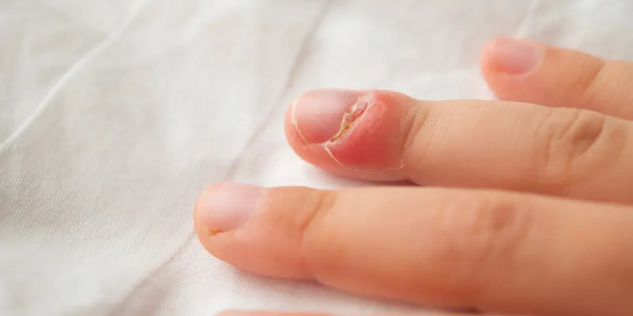 Gros plan sur un doigt d'enfant présentant une rougeur et une inflammation autour de l'ongle, suggérant une mycose ongle bébé.