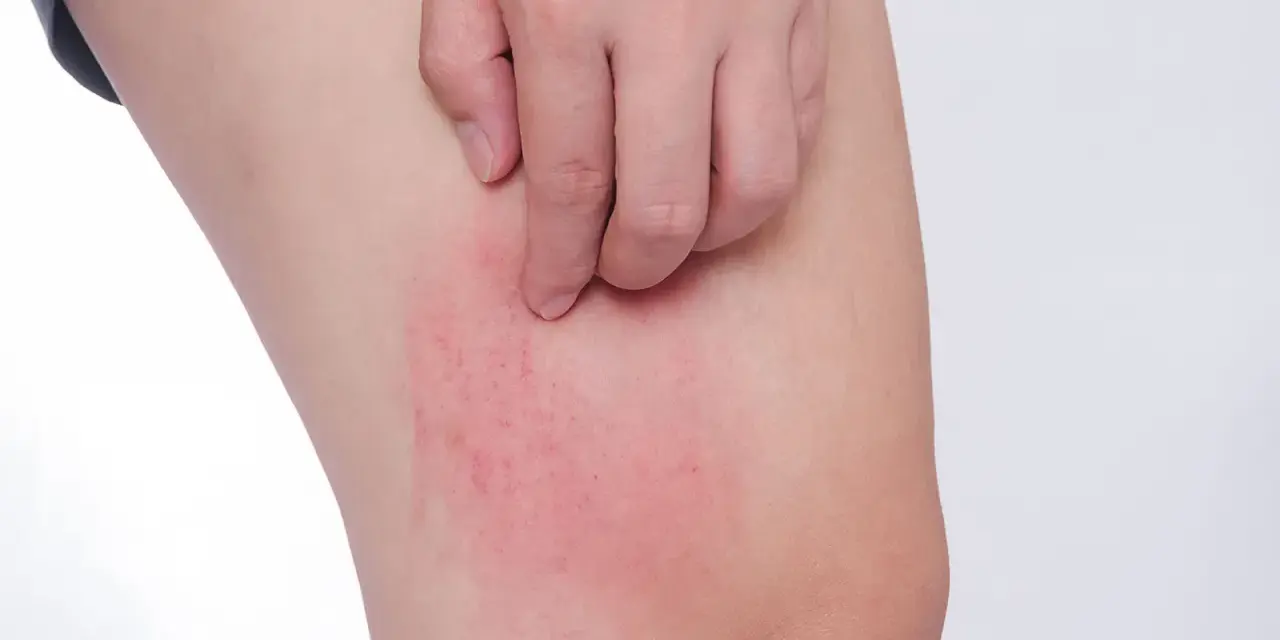 Rote, juckende Stelle am Bein, ein mögliches Symptom von Diabetes haut.