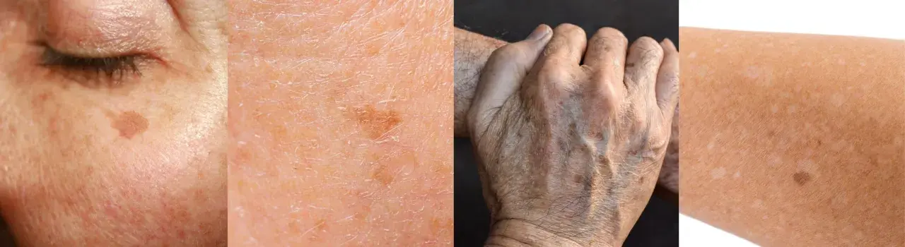 Nahaufnahme von Haut mit Pigmentflecken, Falten und Altersflecken. Retinol gegen Pigmentflecken kann helfen, das Hautbild zu verbessern.