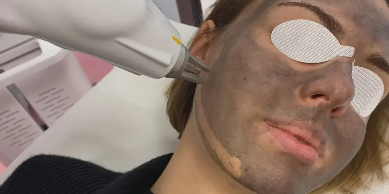 Zabieg laserowy na twarz z maską węglową. Skóra przygotowana do peelingu węglowego.