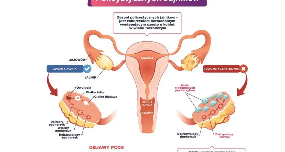 Ilustracja przedstawia budowę jajników, porównując zdrowy jajnik z jajnikiem w zespole policystycznych jajników (PCOS). W tym drugim widoczne są liczne niedojrzałe pęcherzyki.