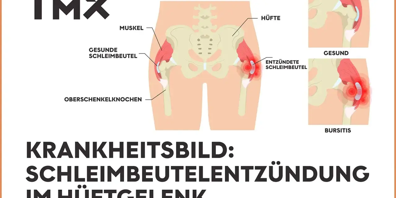 Illustration zeigt das Hüftgelenk mit gesunden und entzündeten Schleimbeuteln. Bursitis trochanterica als Krankheitsbild.