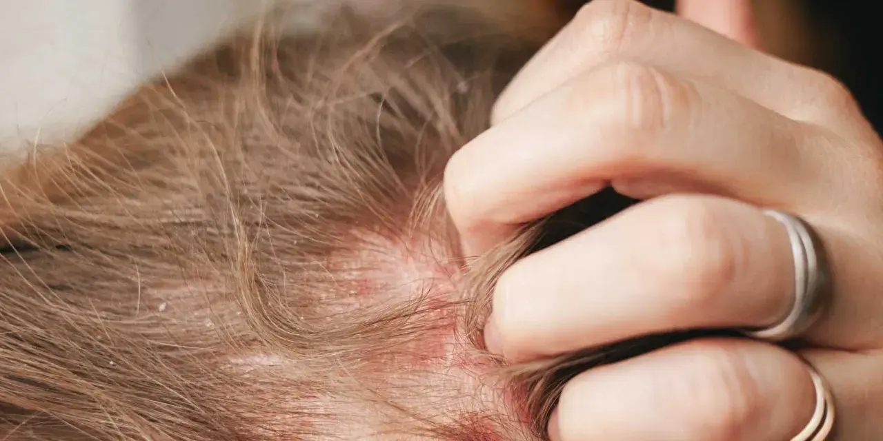 Juckende Kopfhaut mit Rötungen und Schuppen, die auf Neurodermitis hindeuten und zu Haarausfall führen können.