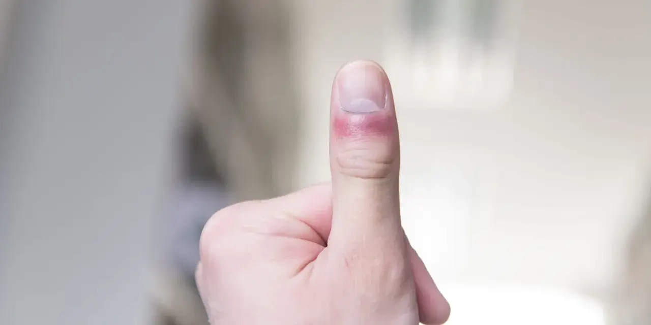 Zastrzał palca z zaczerwienieniem i obrzękiem wokół paznokcia.