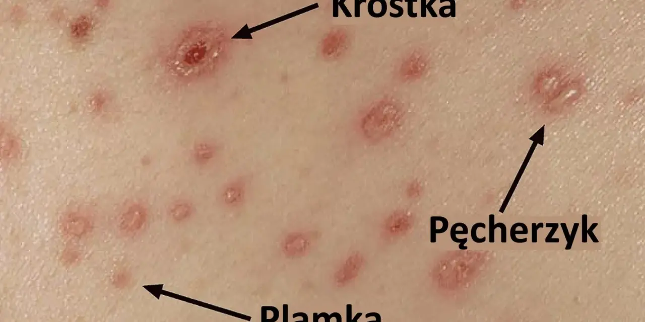 Skóra z licznymi zmianami: plamkami, krostkami i pęcherzykami, typowymi objawami ospy wietrznej.