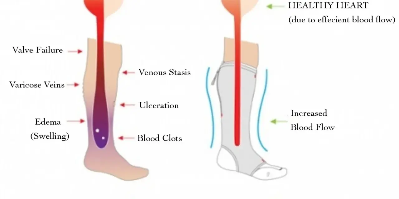 Diagram shows how compression stockings help with inflammation by improving blood flow, preventing issues like edema and varicose veins.