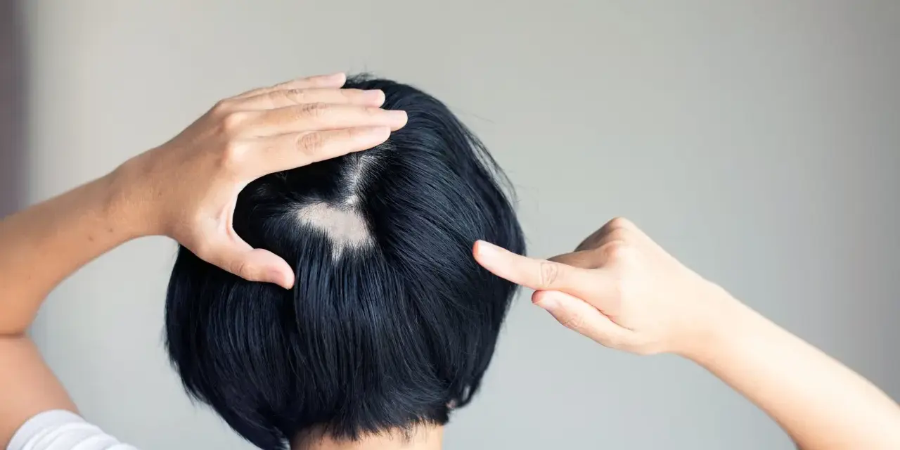 Eine Frau entdeckt kreisrunden Haarausfall am Hinterkopf. Ihre Hände berühren die kahle Stelle, die sich deutlich vom dunklen Haar abhebt.
