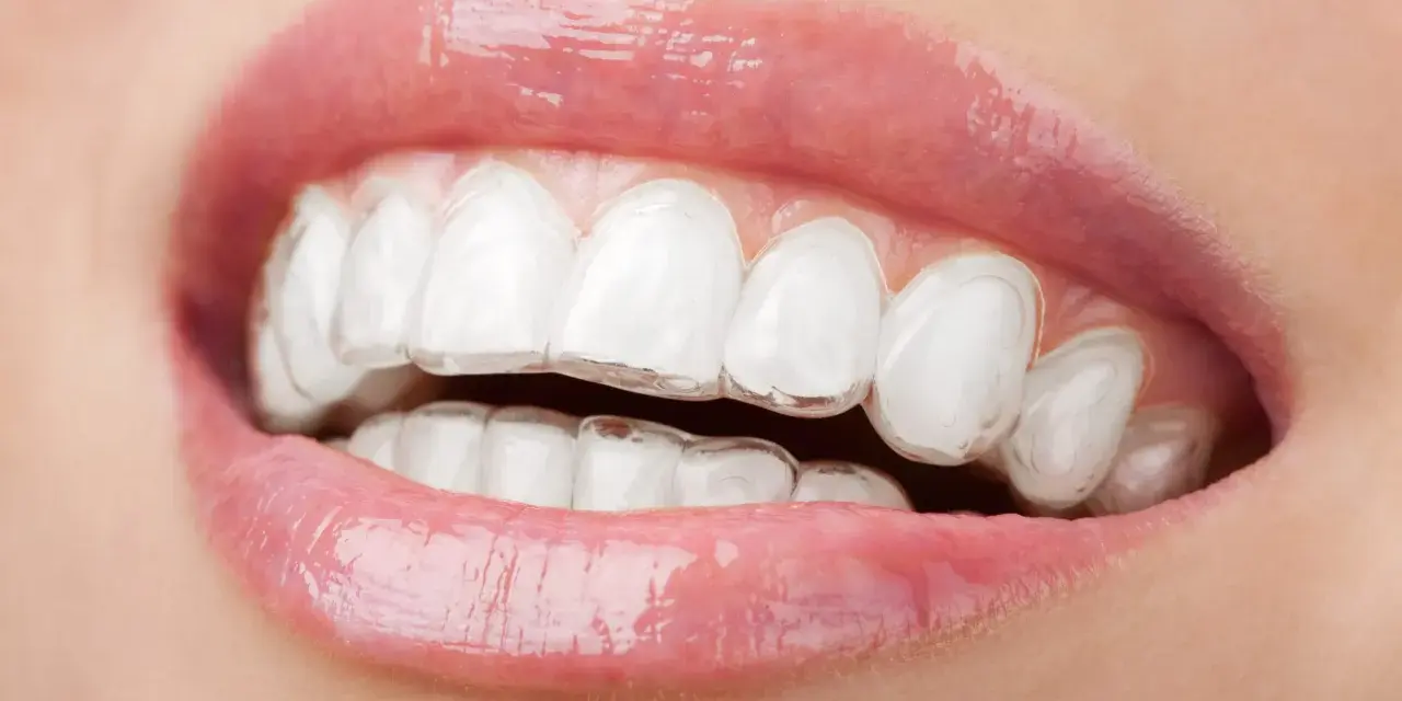 Zbliżenie na usta z widocznym aparatem Invisalign, który dyskretnie koryguje zgryz.