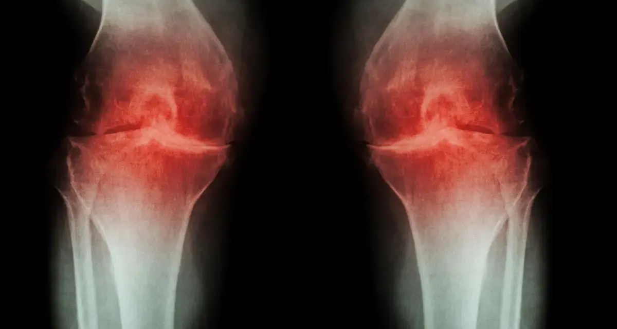 RTG kolan z zaznaczoną osteofitami i zwężeniem szpary stawowej, sugerujące chorobę zwyrodnieniową. Może być wskazana osteotomia podkolanowa.
