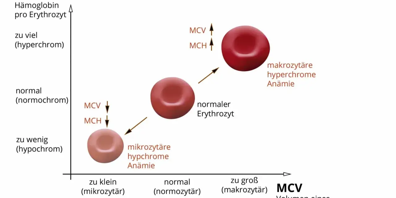 Diagramm zeigt Erythrozytenindizes: MCH (Hämoglobin pro Erythrozyt) und MCV (Volumen). Mikrozytäre, hypochrome Anämie bei niedrigem MCH/MCV. Makrozytäre, hyperchrome Anämie bei hohem MCH/MCV.
