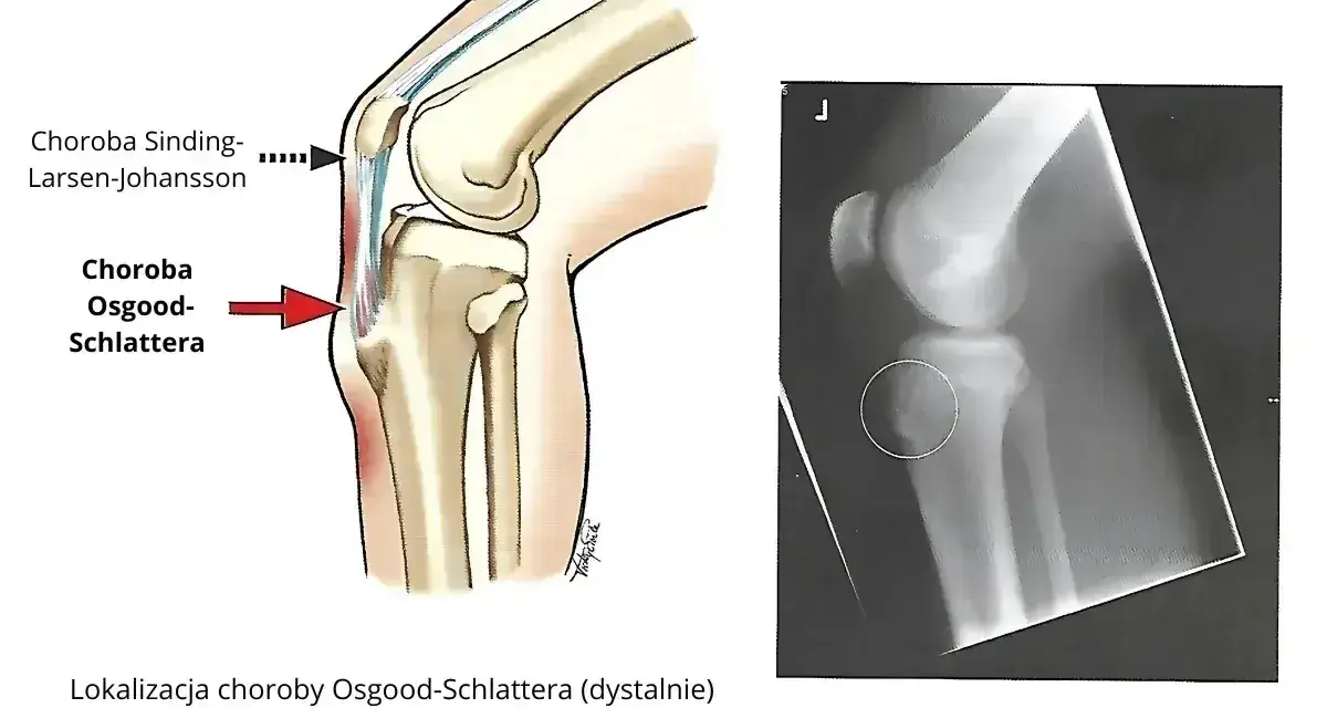 Ilustracja anatomiczna i RTG kolana pokazujące chorobę Osgooda-Schlattera, która objawia się guzowatością kości piszczelowej.