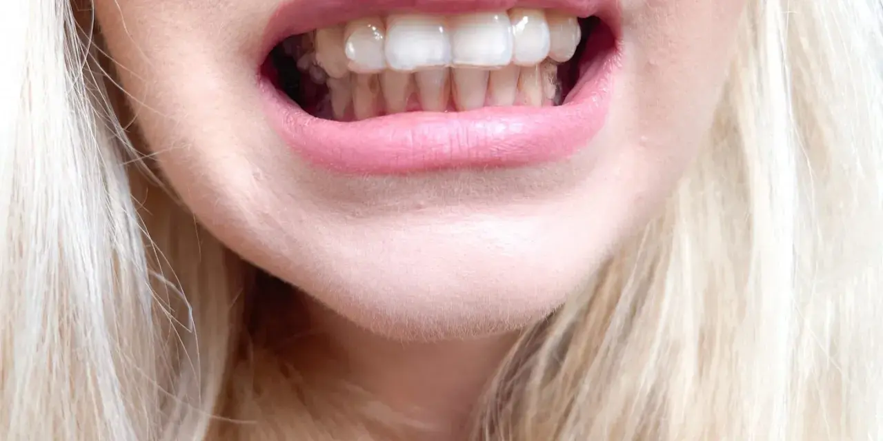 Zbliżenie na usta kobiety z widocznymi przezroczystymi nakładkami Invisalign na zębach.