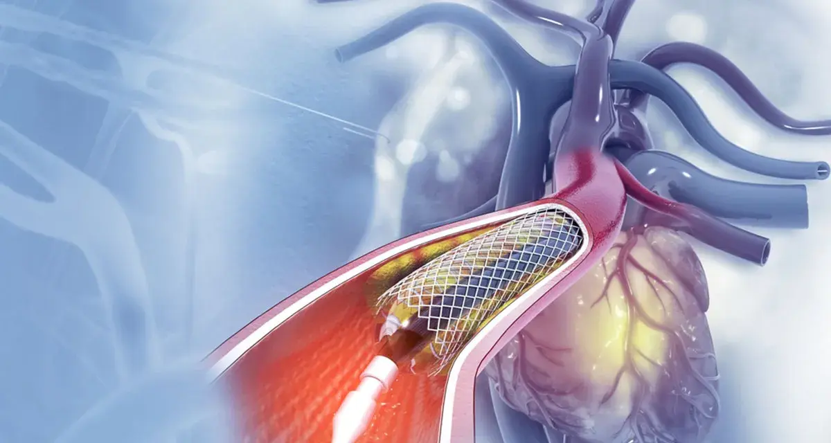 Stent w tętnicy serca podczas zabiegu angioplastyki.