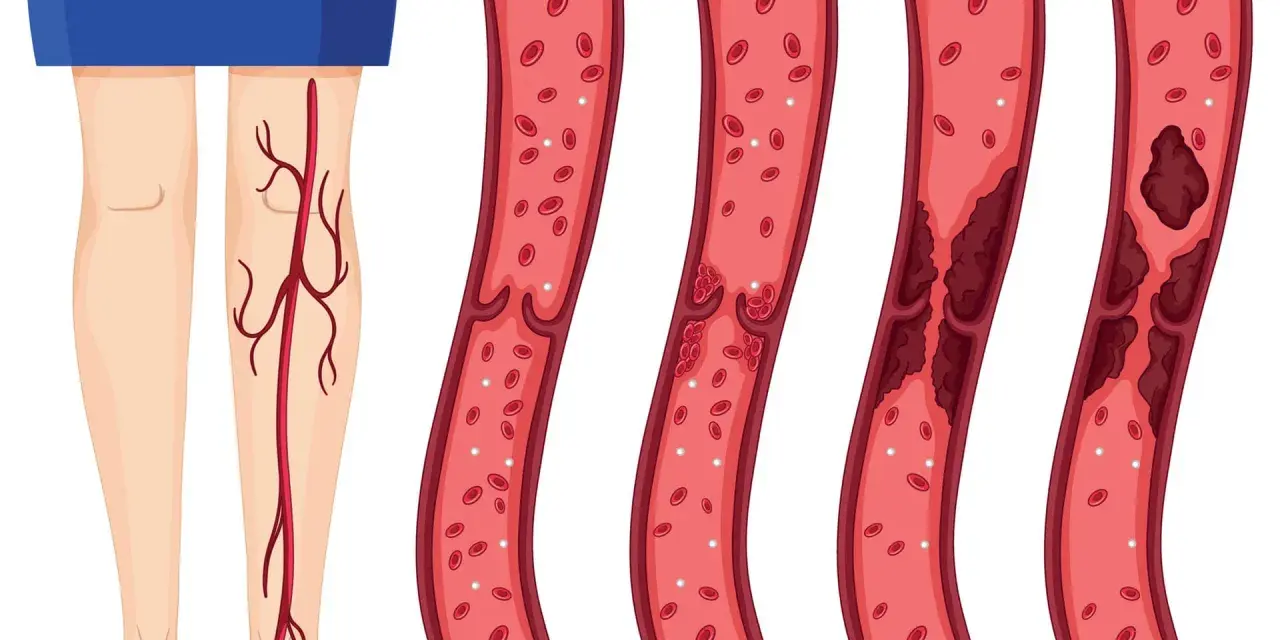 Illustration zeigt gesunde Wade und Blutgefäße mit zunehmender Thrombosebildung. Ein Thrombose Test Wade kann dies aufzeigen.