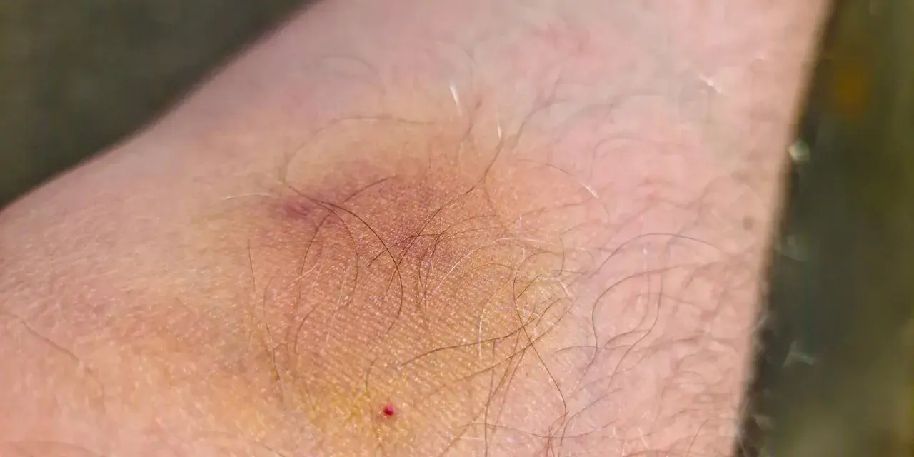Ein blauer Fleck auf der Haut, der leicht juckt. Die Haut ist leicht gerötet und von feinen Härchen bedeckt.