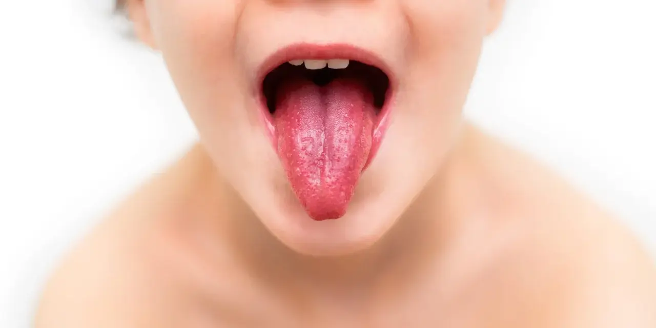 Język dziecka z wybroczynami, objaw szkarlatyny.