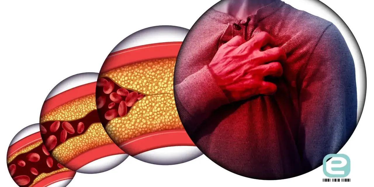 Postępująca choroba wieńcowa: zwężone naczynia krwionośne z cholesterolem i czerwonymi krwinkami, obok mężczyzna trzymający się za serce.