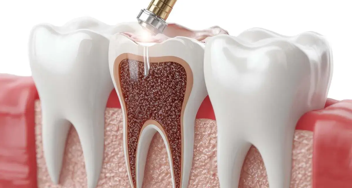 Zabieg stomatologiczny: narzędzie dentystyczne usuwa tkankę z zęba, lecząc zatrucie zęba.