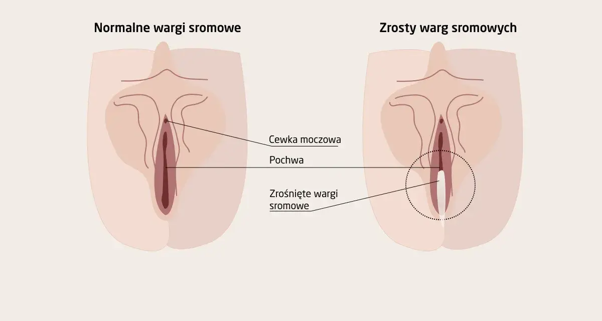 Ilustracja porównuje normalne wargi sromowe z zrośniętymi, które mogą wymagać operacji plastycznej pochwy.