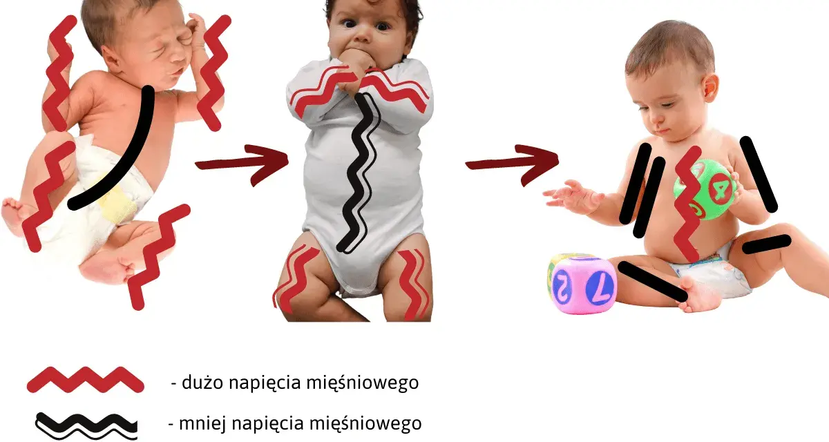 Obrazek pokazuje, jak wzmożone napięcie mięśniowe u niemowląt mija z czasem, od noworodka z mocnym napięciem do starszego dziecka z mniejszym.