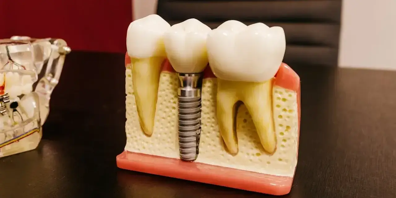 Model szczęki z zębami i mikroimplantem ortodontycznym. Implant zastępuje korzeń zęba, zapewniając stabilne podparcie dla korony.
