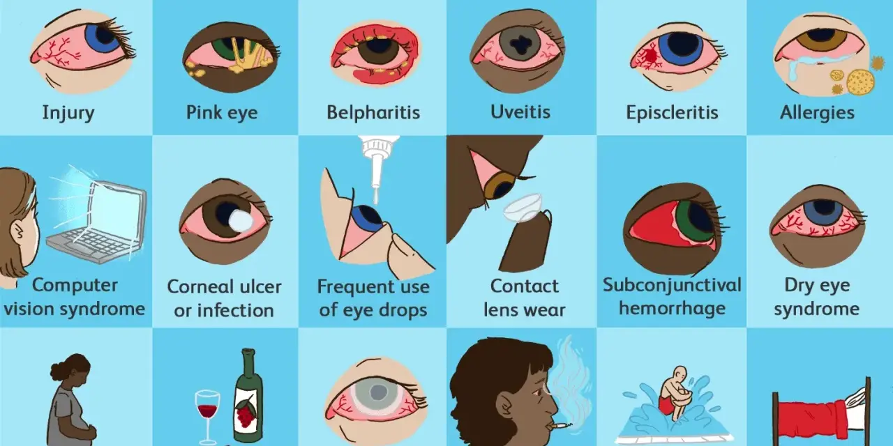 Molte cause possono portare a un occhio sempre rosso: dall'allergia all'uso di lenti a contatto, fino alla stanchezza.