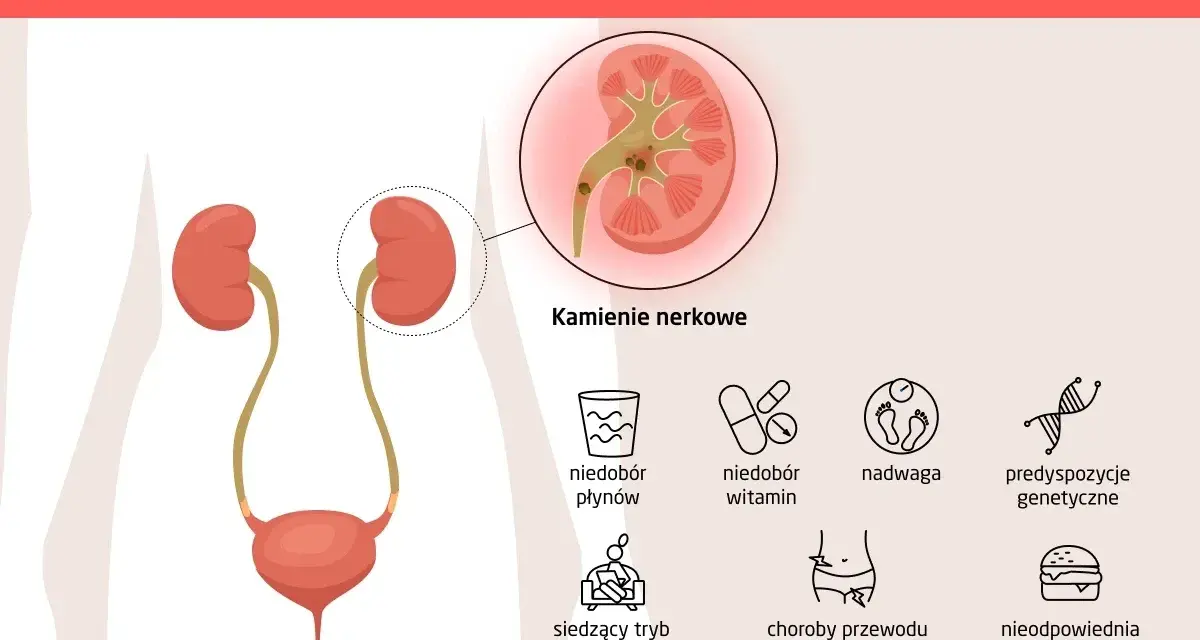Ilustracja przedstawia przyczyny kamicy nerkowej, w tym kamienie nerkowe, niedobór płynów, witamin, nadwagę, predyspozycje genetyczne, siedzący tryb życia, choroby układu pokarmowego i moczowo-płciowego oraz nieodpowiednią dietę.