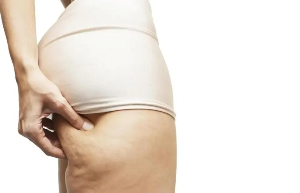 Jak skutecznie walczyć z cellulitem? Poradnik eksperta