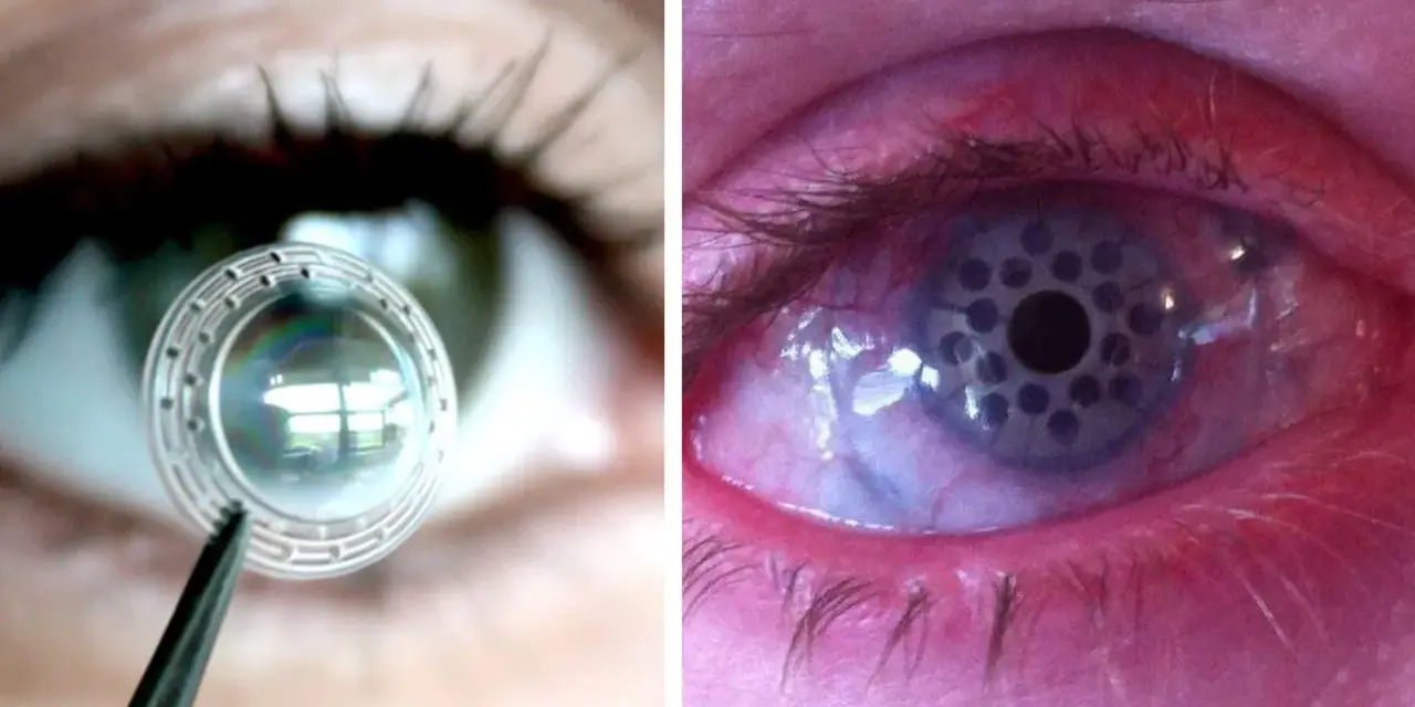Lente per trapianto di retina in fase di applicazione e occhio con impianto retinico.