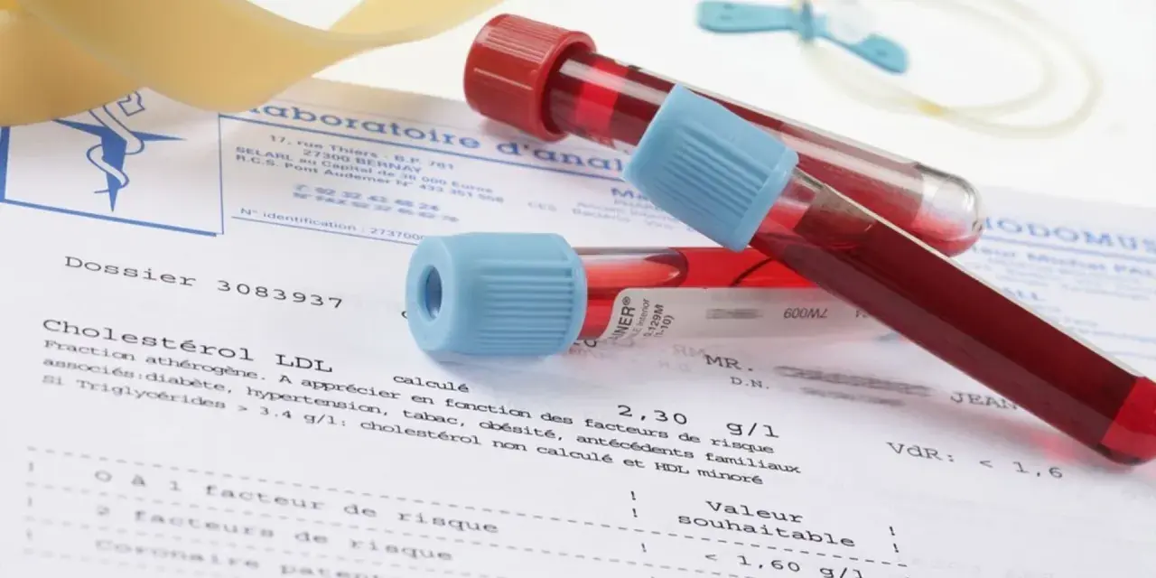 Próbki krwi w probówkach leżą na wynikach badań, gdzie widnieje m.in. poziom cholesterolu LDL. Wyniki mogą wskazywać na potrzebę monitorowania białka c reaktywnego.