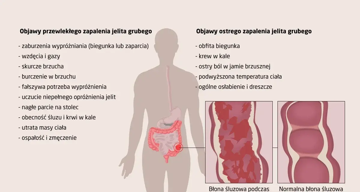 Zapalenie jelita grubego: objawy przewlekłe (biegunka, zaparcia, wzdęcia, bóle brzucha) i ostre (obfita biegunka, krew w kale, gorączka).