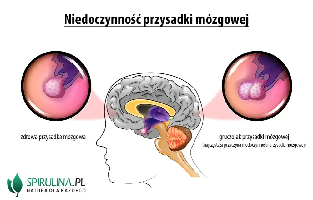 Mgła mózgowa, lęk, depresja? To może być gruczolak przysadki