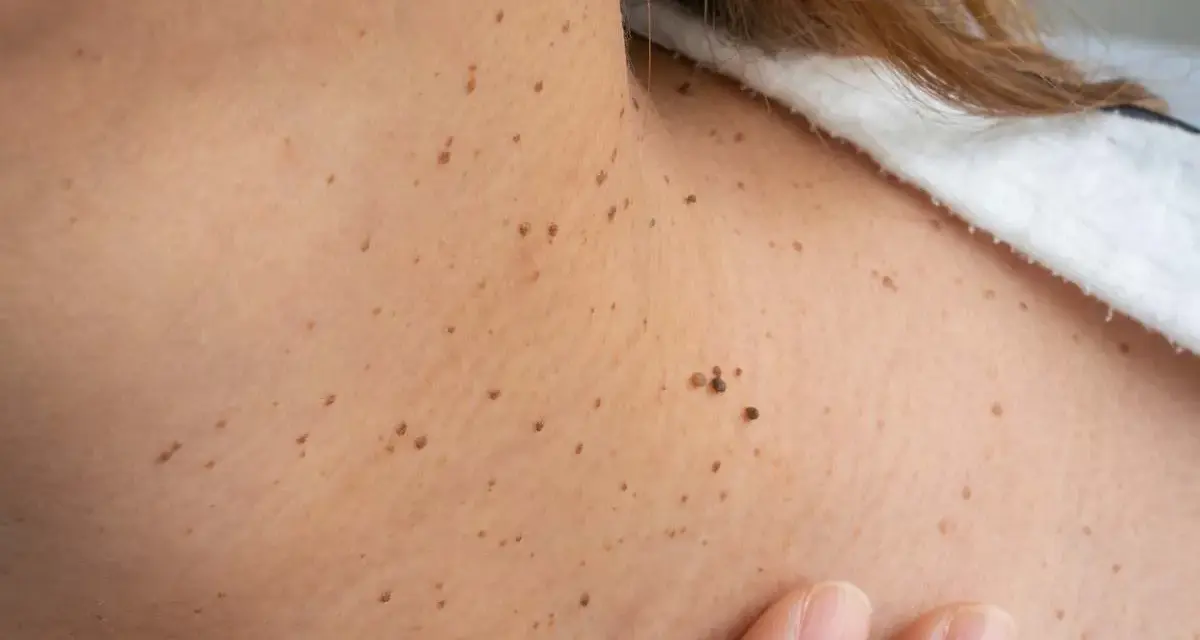 Primer plano de la piel del cuello con numerosas verrugas y lunares. Una mano toca suavemente la piel.