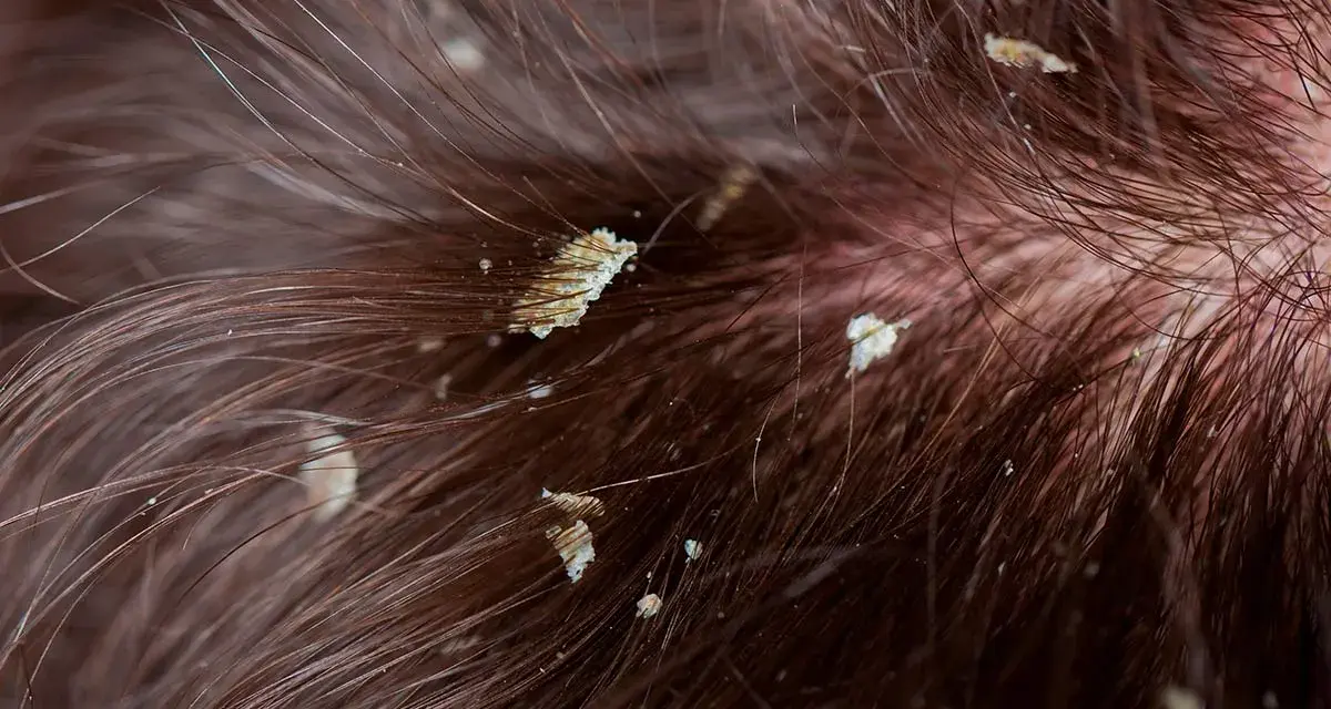 Primer plano de cabello castaño con descamación en el cuero cabelludo, mostrando escamas blancas y amarillentas entre los mechones.