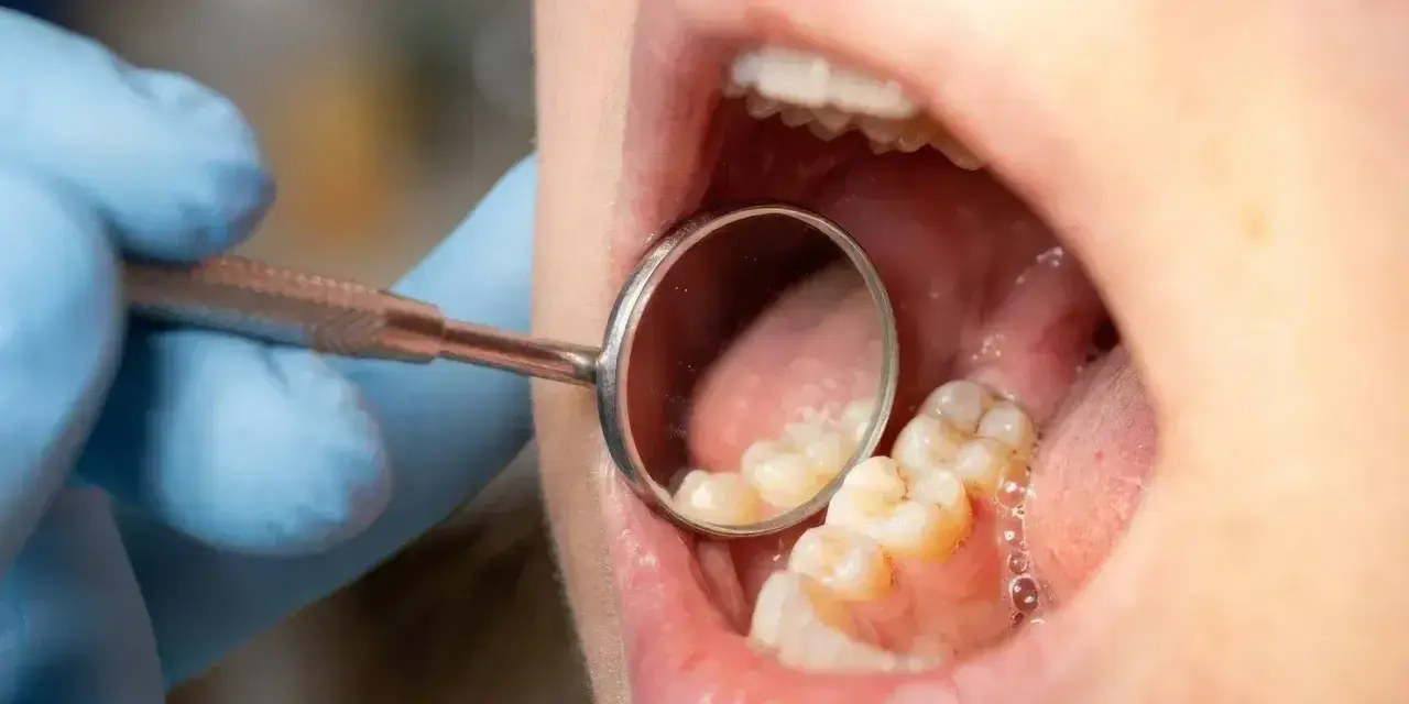 Dentysta bada zęby, używając lusterka do sprawdzenia szyjki zęba i okolicznych tkanek.