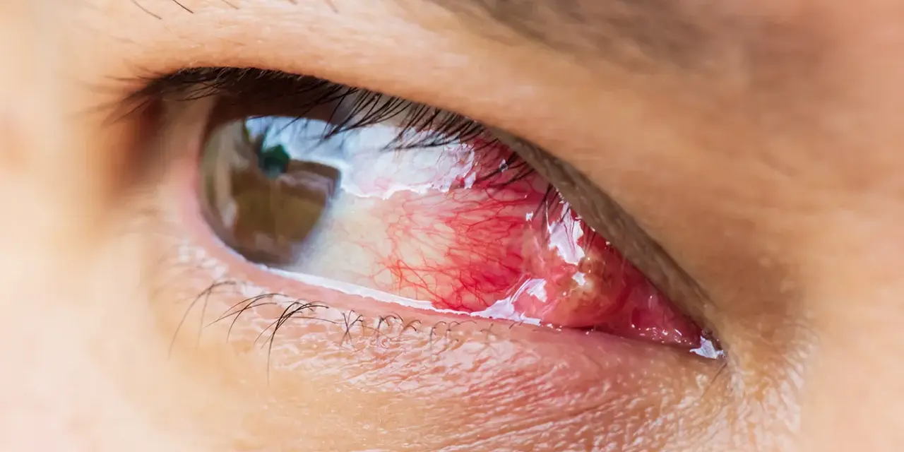 Occhio con pterigio arrossato e infiammato, in attesa di un intervento laser per rimuoverlo.